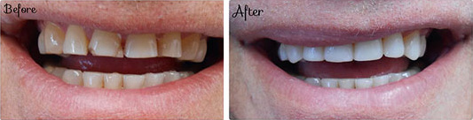 Composite Veneers